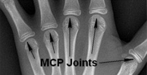 knuckle joint x-ray